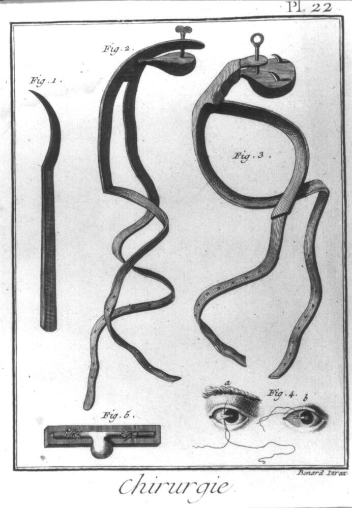 Chirurgie, Pl. 22, vijf instrumenten van chirurgiegereedschap zoals dat aan boord werd gebruikt, gravure, 18e eeuw